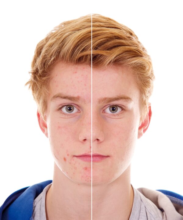 Acne and Blemish Treatment Elixir - Image 2