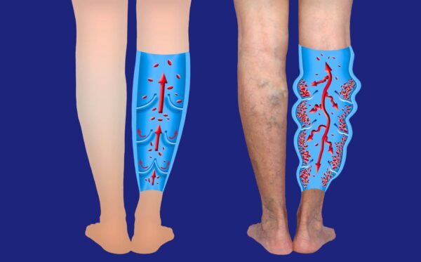Forces of Nature Varicose Vein Defense Elixir - Image 2