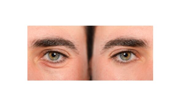 Under Eye Treatment Elixir